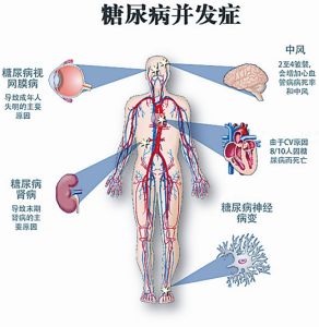 糖尿病併發症