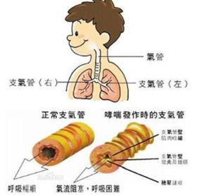 過敏性支氣管炎