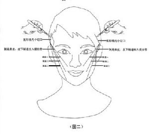 ast面部提升