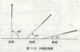 平刺法