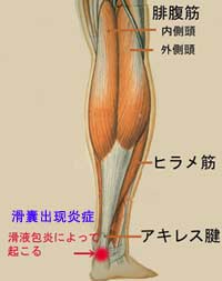 跟腱前囊炎