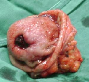 胃腸道間質瘤