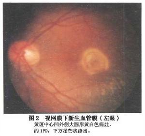 視網膜下新生血管膜