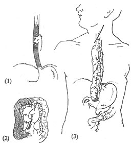 食管瘢痕性狹窄右半結腸代食管術