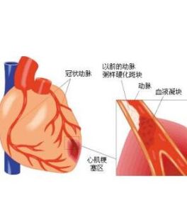 妊娠性心肌梗死