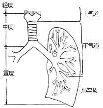 吸入性損傷