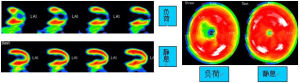 PET心肌灌注顯像