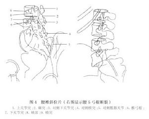 （圖）腰部峽部崩裂和脊椎滑脫