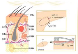 納米無痕定向清除術