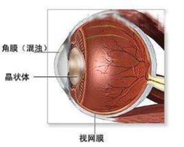 角膜異物取出術