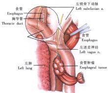 示意圖4:縱行切開縱隔胸膜，游離出食管