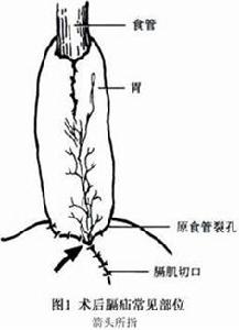 手術後膈疝 圖1