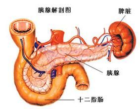 急性出血性胰腺炎