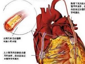 右室心肌梗死