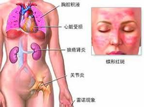 系統性紅斑狼瘡診斷