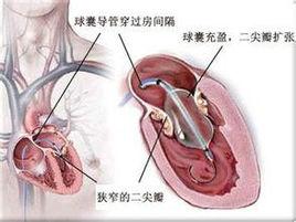 經皮球囊肺動脈瓣成形術