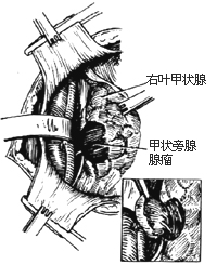 甲狀旁腺切除術