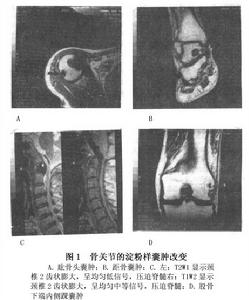 透析性骨關節病