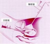 輸卵管通水