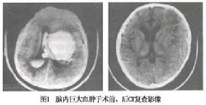 腦室內出血