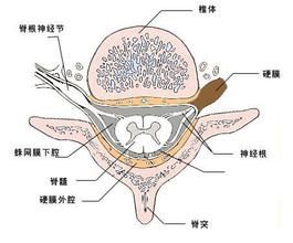 脊髓蛛網膜炎