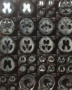 急性化膿性腦膜炎