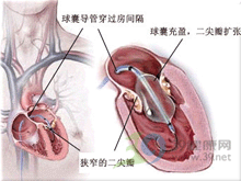 先天性二尖瓣畸形