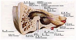 鼓室上隱窩相關解剖模式圖