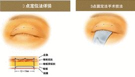 三點定位雙眼皮