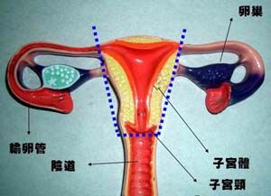 子宮切除