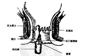 （圖）老年人缺血性結腸炎