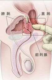 肛門周圍癌