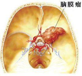 良性腦瘤