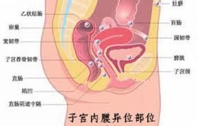 子宮內膜異位性不孕