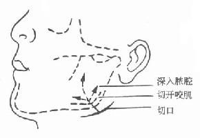 口腔頜面部損傷