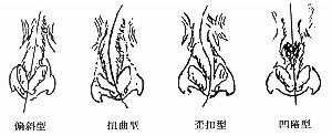 鼻中隔偏曲