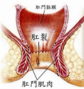 痙攣性肛門直腸痛