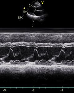 M型超聲心動圖