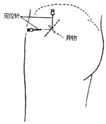 軟組織金屬異物取出術