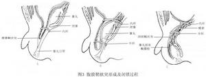 小兒腹股溝斜疝