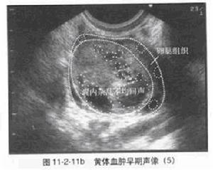 黃體囊腫