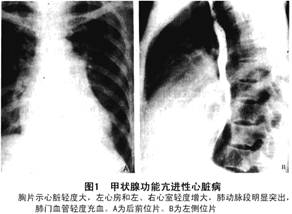 甲狀腺功能亢進性心肌病