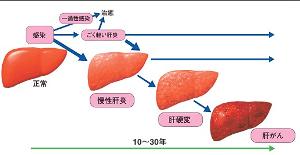 慢性肝炎