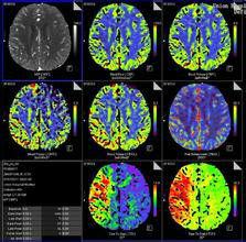 CT灌注成像