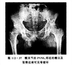 色素沉著絨毛結節性滑膜炎