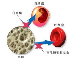 再生障礙性貧血