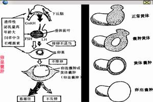 黃體囊腫