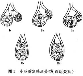 小腸重複畸形