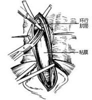 示意圖4:切開上段環行肌層