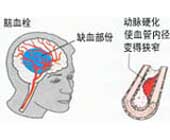 腦膜炎